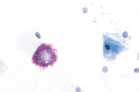 Fig. 13.31, Angiokeratoma corporis diffusum: urinary sediment stained with toluidine blue. The metachromasia (purple coloration) is due to the presence of intracytoplasmic sulfatides.