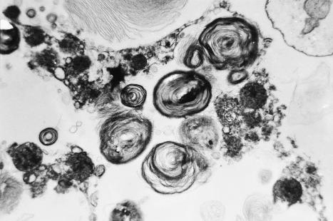 Fig. 13.32, Angiokeratoma corporis diffusum: electron micrograph of urine sediment, showing typical concentrically lamellated inclusions.