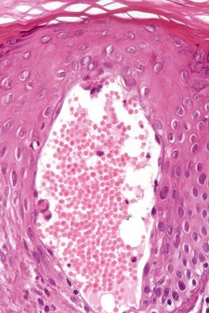 Fig. 13.34, Angiokeratoma corporis diffusum: close-up view.