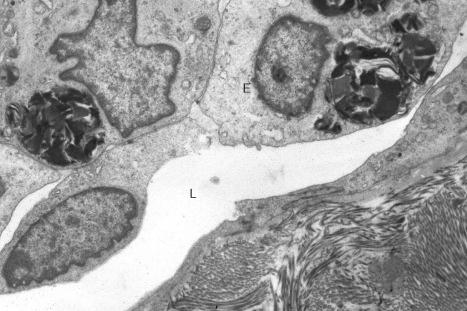 Fig. 13.35, Angiokeratoma corporis diffusum: the endothelial cells of this small blood vessel contain typical inclusions (L, lumen; E, endothelial cell).