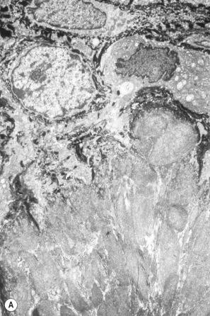 Fig. 13.38, Cutaneous amyloidosis: ( A ) electron micrograph of macular amyloidosis showing nodular deposits in the superficial dermis; ( B ) the characteristic randomly orientated, straight, nonbranching appearance of amyloid filaments.