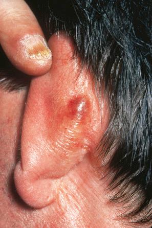 Fig. 13.39, Primary systemic amyloidosis: a waxy nodule is present behind the ear. Note the purpura.