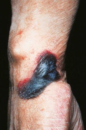 Fig. 13.40, Primary systemic amyloidosis: hemorrhagic bullous lesion on wrist.