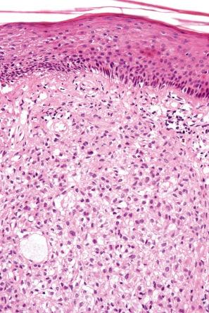 Fig. 13.4, Eruptive xanthoma: biopsy of an established lesion. The histiocytes have abundant vacuolated cytoplasm.