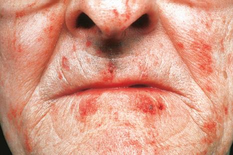 Fig. 13.42, Primary systemic amyloidosis: erythematous and purpuric lesions on the face of an elderly male. By courtesy of the Institute of Dermatology, London, UK.