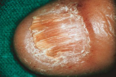 Fig. 13.45, Primary systemic amyloidosis: nail dystrophy as seen in this example is a very rare manifestation.