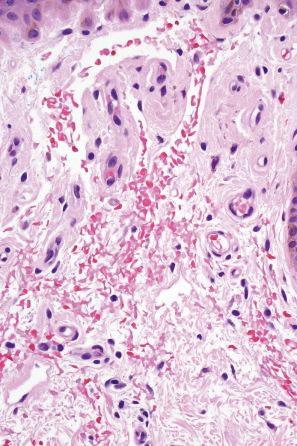 Fig. 13.48, Primary systemic amyloidosis: high-power view of Fig. 13.47 . Note the red cell extravasation.