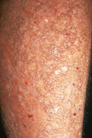 Fig. 13.52, Lichen amyloidosis: scaly lichenoid papules on the shin.