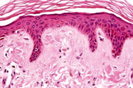 Fig. 13.55, Macular amyloidosis: close-up view of faceted deposits.