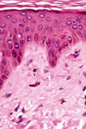 Fig. 13.56, Macular amyloidosis: pigmentary incontinence is typically present.