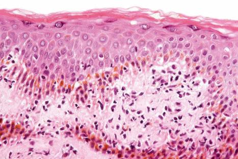 Fig. 13.58, Lichen amyloidosis: in this view, there is interface change and a lymphocytic infiltrate.