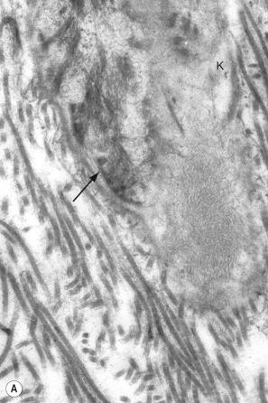 Fig. 13.59, Lichen amyloidosis: ( A ) early filamentous degeneration is seen in this basal keratinocyte ( K ), lamina densa is arrowed; ( B ) compare the organized appearance of the tonofilaments with the haphazardly orientated amyloid immediately adjacent to the lamina densa.