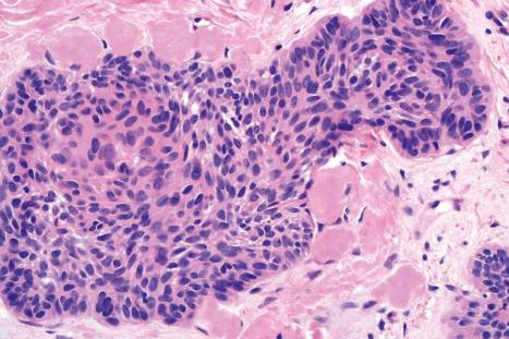 Fig. 13.60, Tumor-associated amyloid: amyloid deposits in a basal cell carcinoma.