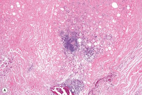 Fig. 13.62, Nodular amyloidosis: ( A ) massive deposits of amyloid are present in the dermis; ( B ) there is a heavy associated plasma cell infiltrate.