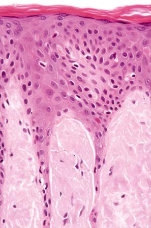 Fig. 13.64, Nodular amyloid: the amyloid deposits fill the papillary dermis.