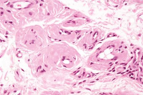 Fig. 13.65, Nodular amyloidosis: amyloid deposits have thickened the blood vessel walls.