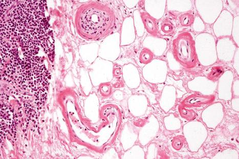 Fig. 13.67, Nodular amyloid: in this example, vessels in the subcutaneous fat showing striking involvement.