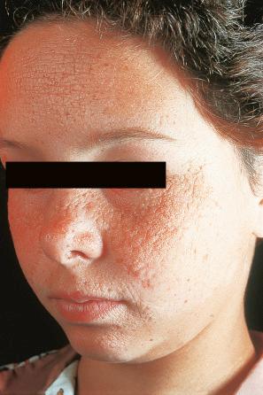 Fig. 13.69, Juvenile colloid milium: there is papular thickening of the skin, particularly involving the cheeks, nose, and forehead.