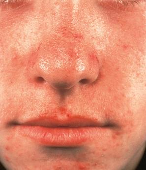 Fig. 13.70, Juvenile colloid milium: this less severely affected child shows typical yellow–brown translucent papules on the nose and upper lip.