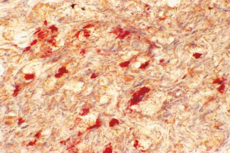 Fig. 13.7, Eruptive xanthoma: the lipid within the macrophages stains positively with oil red O.