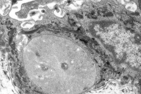 Fig. 13.72, Juvenile colloid milium: this shows an apoptotic keratinocyte, the cytoplasm of which is filled with fascicles of pale-staining filaments that contrast strikingly with adjacent tonofilaments.