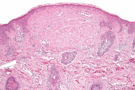 Fig. 13.74, Juvenile colloid milium: the papule consists of an intradermal deposit of eosinophilic material. There is no inflammatory response.