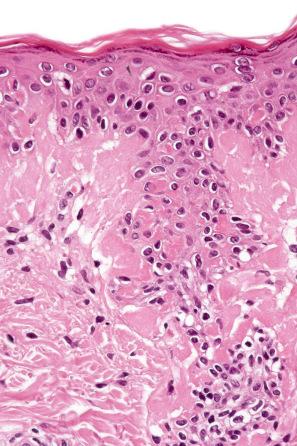 Fig. 13.76, Juvenile colloid milium: the adjacent epidermis shows massive apoptosis.