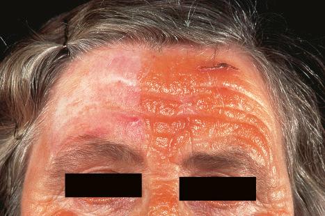 Fig. 13.78, Adult colloid milium: predominantly unilateral, streaked, orange plaque involving the forehead and nose.