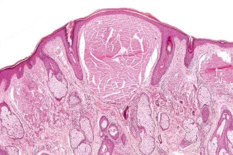 Fig. 13.79, Adult colloid milium: deposits of eosinophilic material are present in the superficial dermis. There is adjacent solar elastosis.