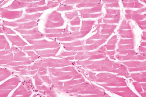 Fig. 13.80, Adult colloid milium: the typical faceted appearance.