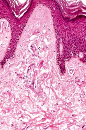 Fig. 13.84, Lipid proteinosis: the blood vessel walls are thickened by pale-staining, eosinophilic homogeneous material.