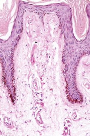 Fig. 13.86, Lipoid proteinosis: the deposit is strongly periodic acid–Schiff positive (diastase-resistant).