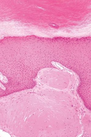 Fig. 13.89, Macroglobulinosis cutis: these are nodular deposits of eosinophilic material in the superficial dermis.