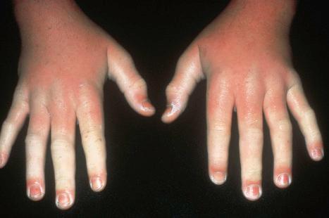 Fig. 13.92, Congenital erythropoietic porphyria (Gunther disease): this variant is associated with severe photosensitivity. There is marked erythema and edema of the backs of the hands and fingers. Scarring frequently supervenes.