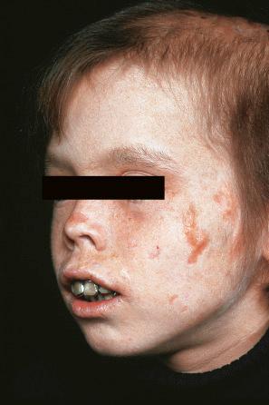 Fig. 13.93, Congenital erythropoietic porphyria (Gunther disease): in this severely affected patient, there is marked hyperpigmented scarring on the cheeks, nose, and around the mouth. The brownish discoloration of the teeth is characteristic.