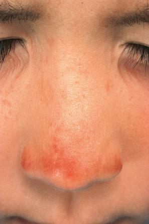 Fig. 13.97, Erythropoietic protoporphyria: there are characteristic, depressed, small linear scars on the bridge and sides of this patient's nose.