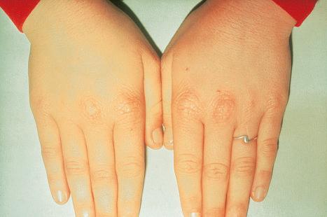 Fig. 13.100, Erythropoietic protoporphyria: there is characteristic waxy thickening of the skin of the hands.