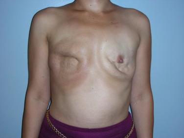 Fig. 13.2, A typical patient has a missing portion of the pectoralis major muscle in her right anterior chest wall and significant radiation damage to the remaining breast skin. In this patient, a latissimus dorsi flap should be used to replace the radiated breast skin and missing portion of the pectoralis major muscle for an implant-based breast reconstruction.