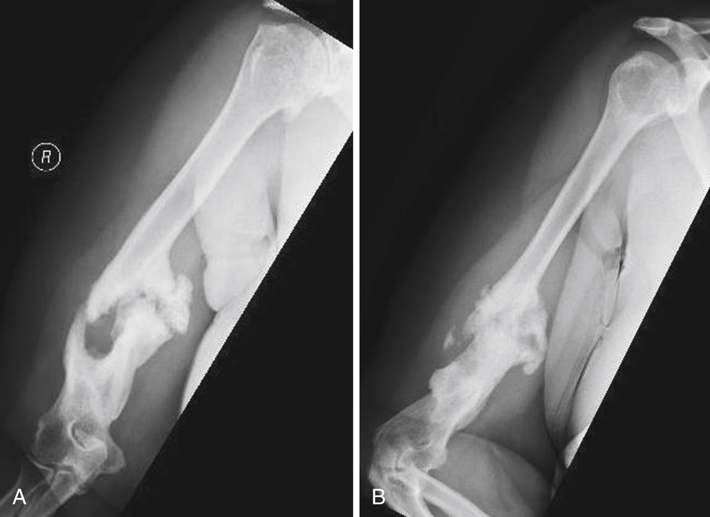 FIGURE 59.4, A and B, Hypertrophic humeral nonunion.