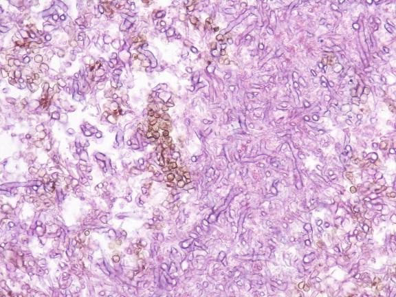 Figure 25-2, Dematiaceous spores and occasional dematiaceous hyphae interspersed with hyaline hyphae, demonstrating the sometimes-focal nature of pigmentation (H&E, 100 × original magnification).