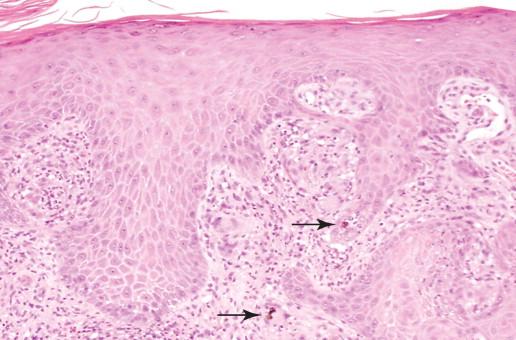 Figure 25-3, Typical H&E–stained appearance of chromoblastomycosis from a skin biopsy specimen. Note the prominent epithelial hyperplasia and two deeply pigmented muriform bodies (arrows; 100 × original magnification).