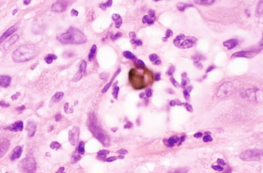 Figure 25-4, H&E stain demonstrating a muriform with a thick outer cell wall and intersecting septations. Scattered neutrophils are also present (1000 × original magnification).