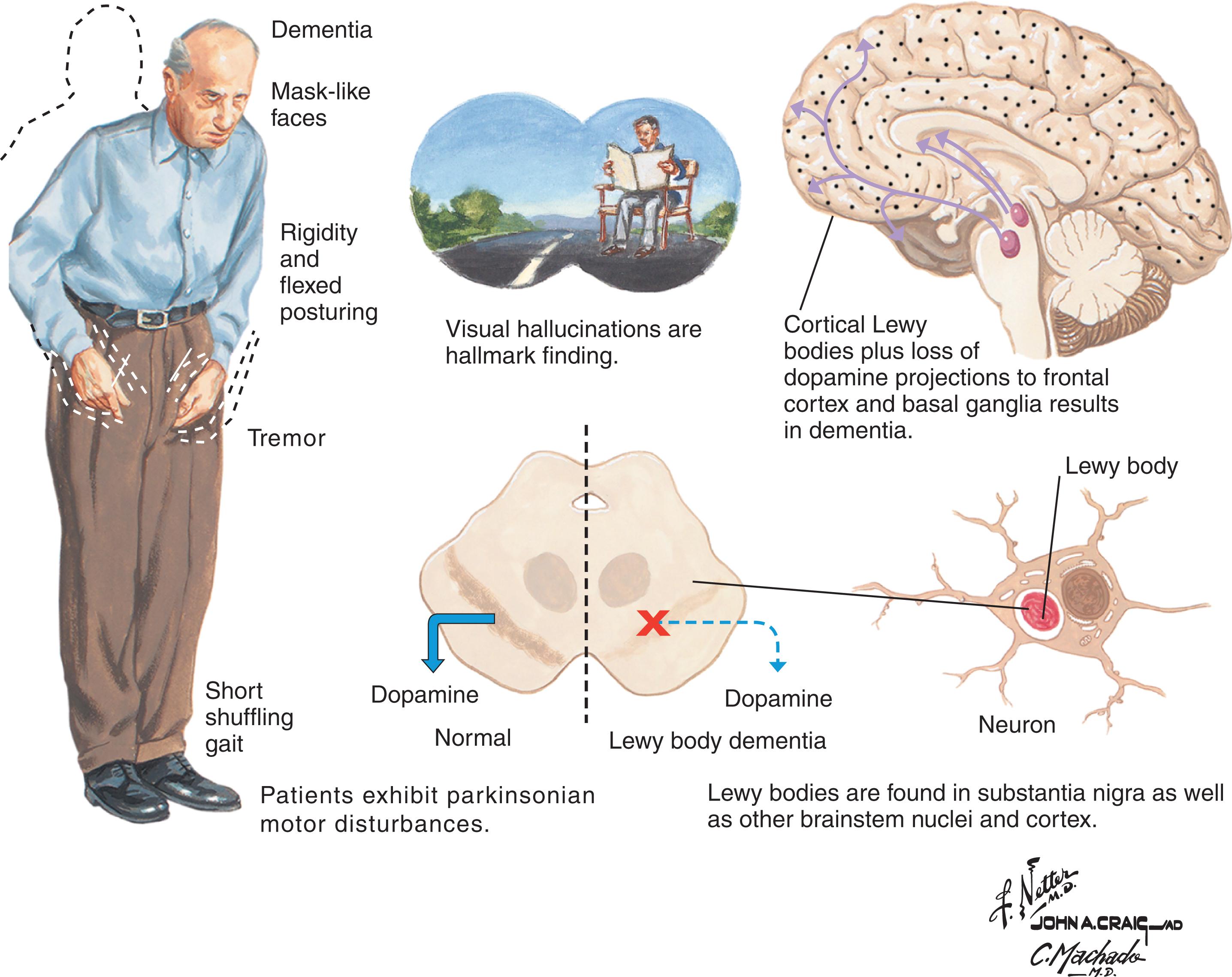 Fig. 8.1, Major clinical and pathological abnormalities in dementia with Lewy bodies.