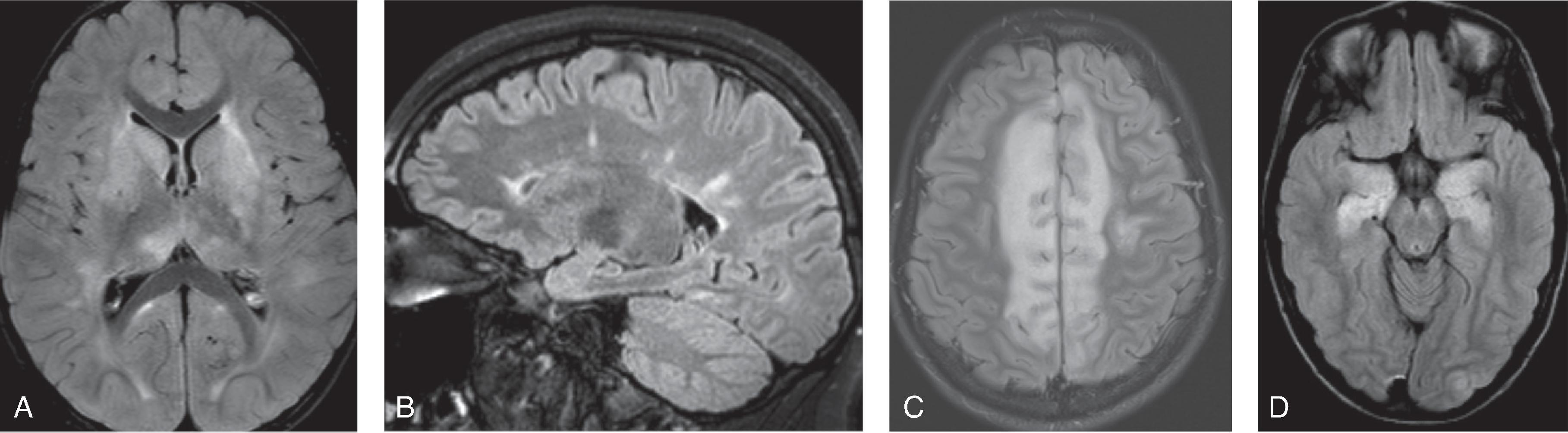 Fig. 6.1, Wide range of imaging findings seen with representative demyelinating and inflammatory disorders of (A) ADEM, (B) multiple sclerosis, (C) anti-MOG demyelination, and (D) autoimmune encephalitis.