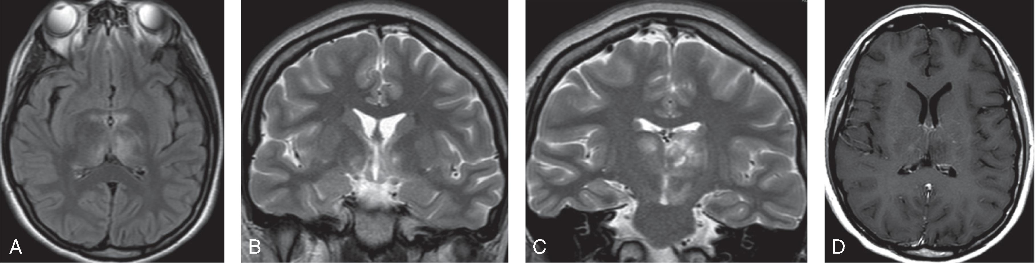 Fig. 6.14, Neuromyelitis Optica (NMO).