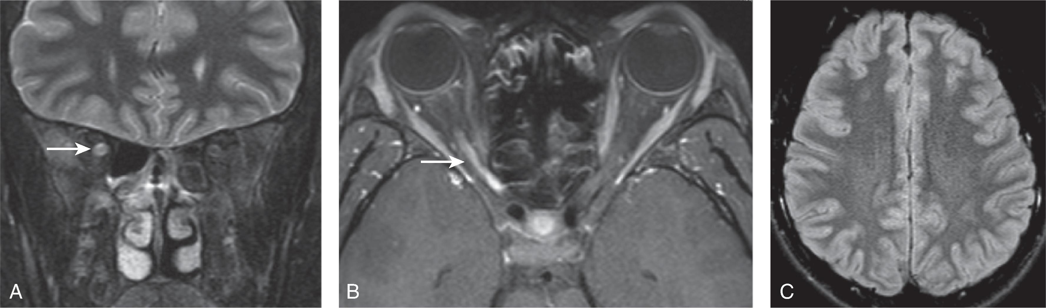 Fig. 6.15, Neuromyelitis Optica (NMO).