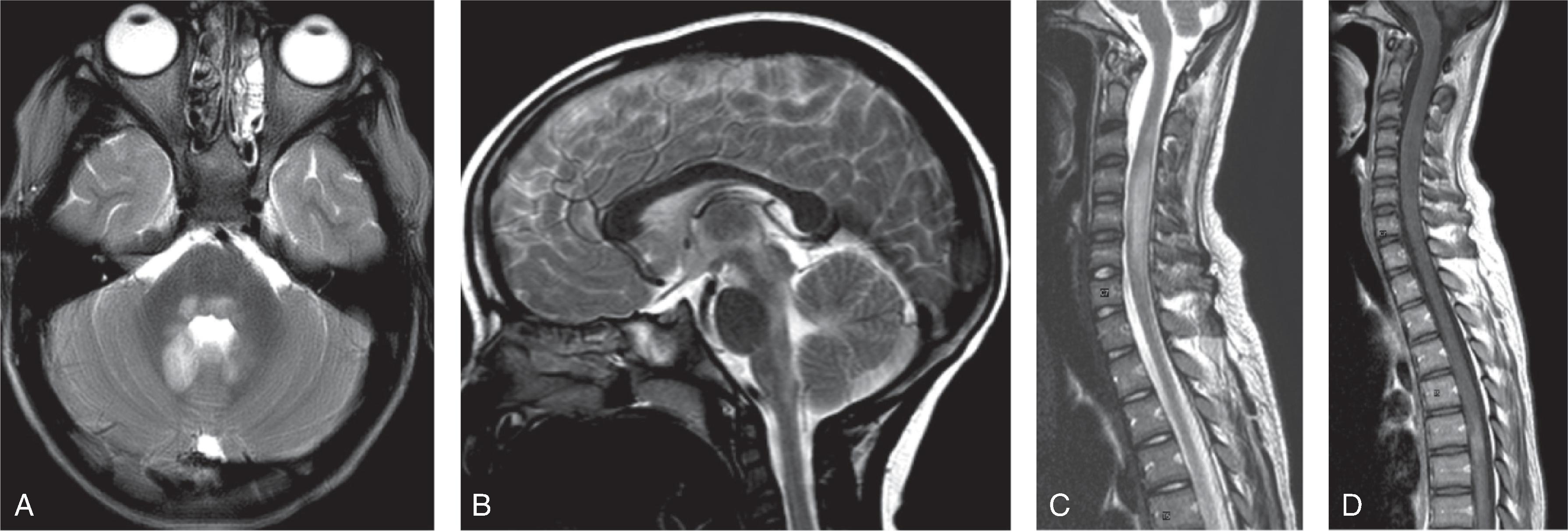 Fig. 6.16, Neuromyelitis Optica (NMO): Two Patients.