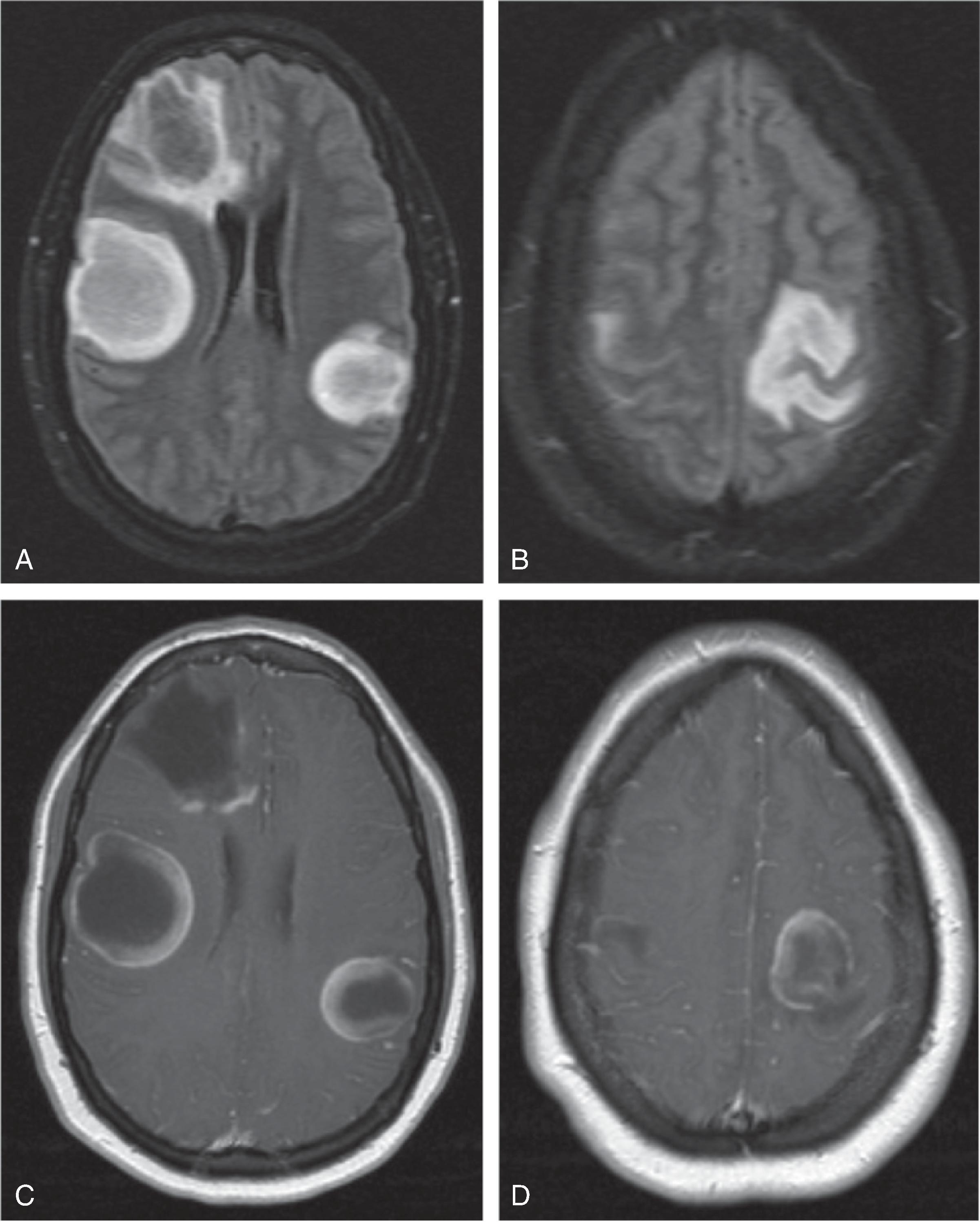 Fig. 6.17, Tumefactive Demyelination.