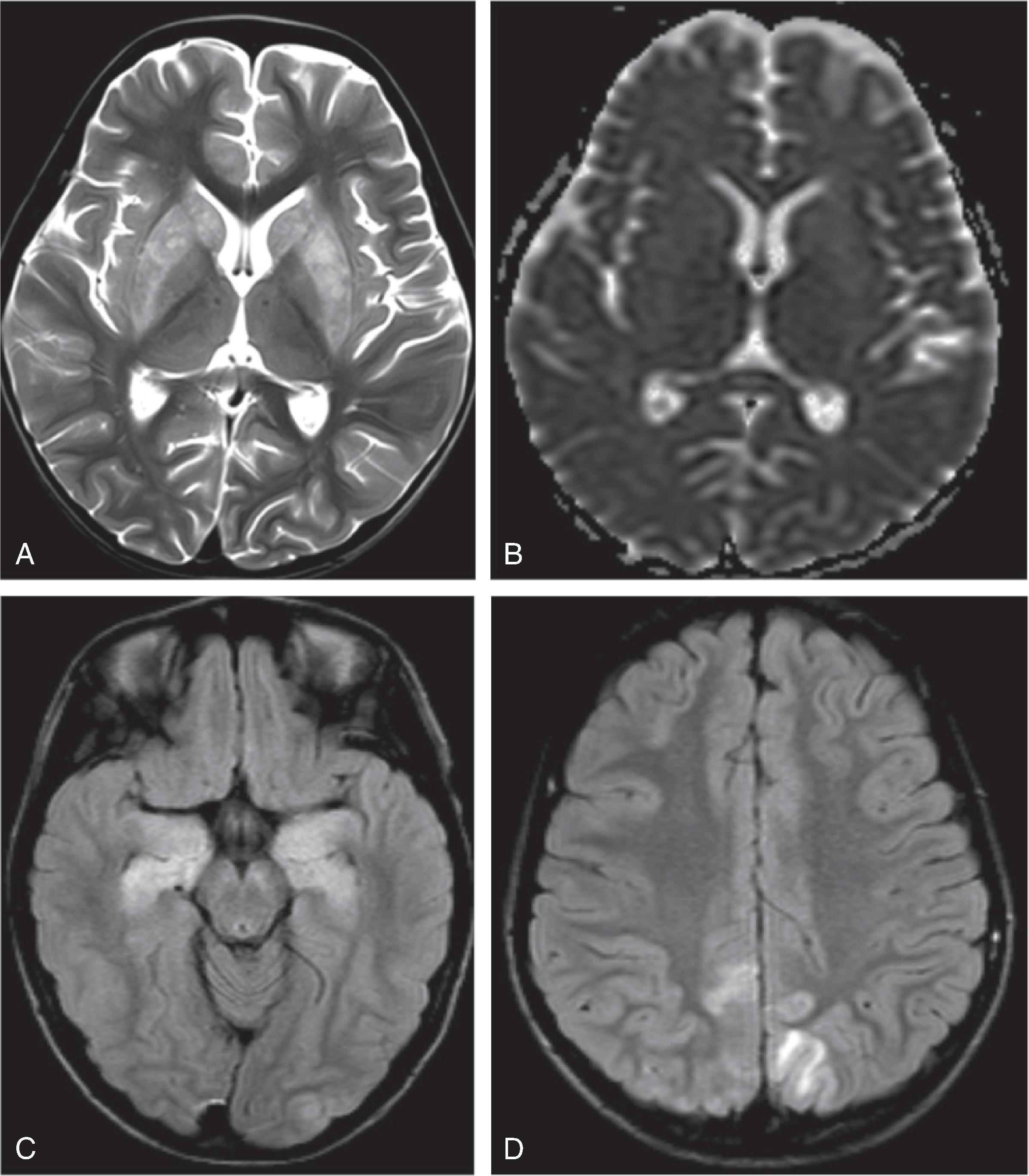 Fig. 6.18, Autoimmune Encephalitis.
