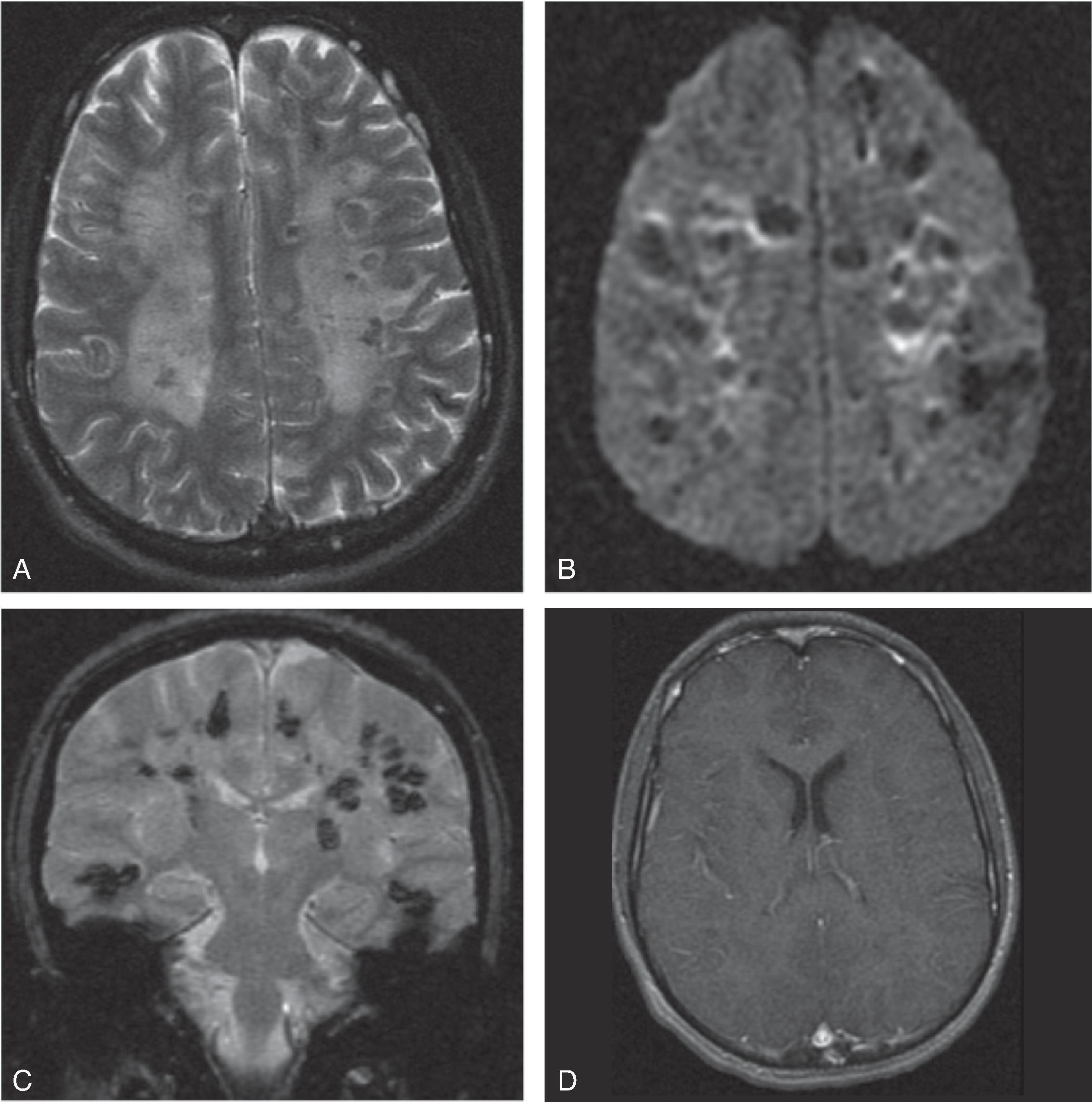 Fig. 6.19, Acute Hemorrhagic Leukoencephalitis.